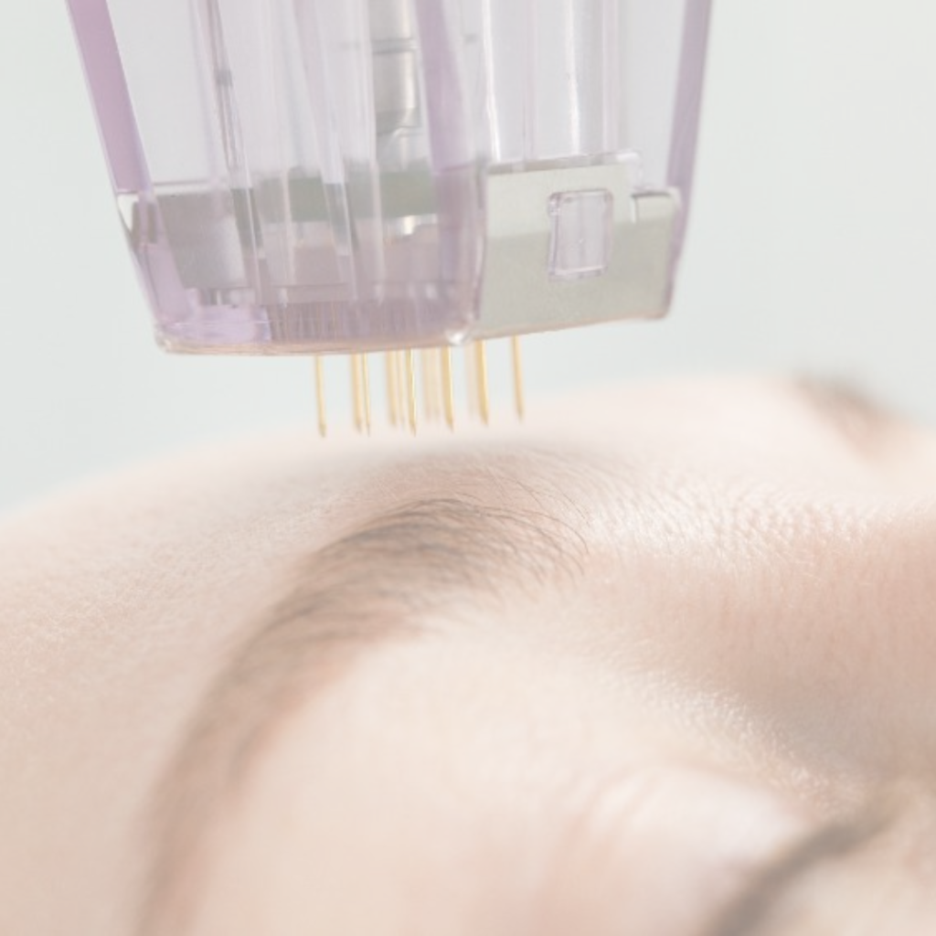 Advanced Morpheus8 treatment for skin enhancement at Beyond Beautiful By Melissa